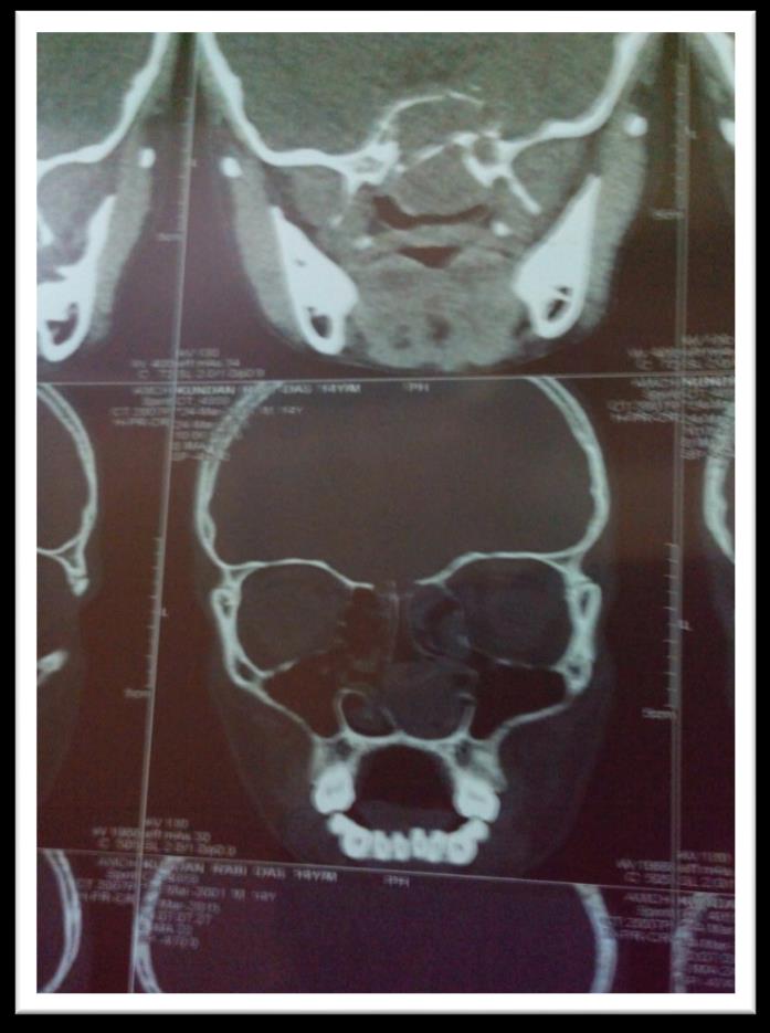 Figure 2: Category 1 Shows Opd Cases, Category 2 Shows risk group attended Opd for any cause, Category 3 Shows total risk group admitted for any cause.