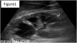 Figure 1: Ultrasound image of left renal: uretero- hydronephrosis with peri-renal collection.