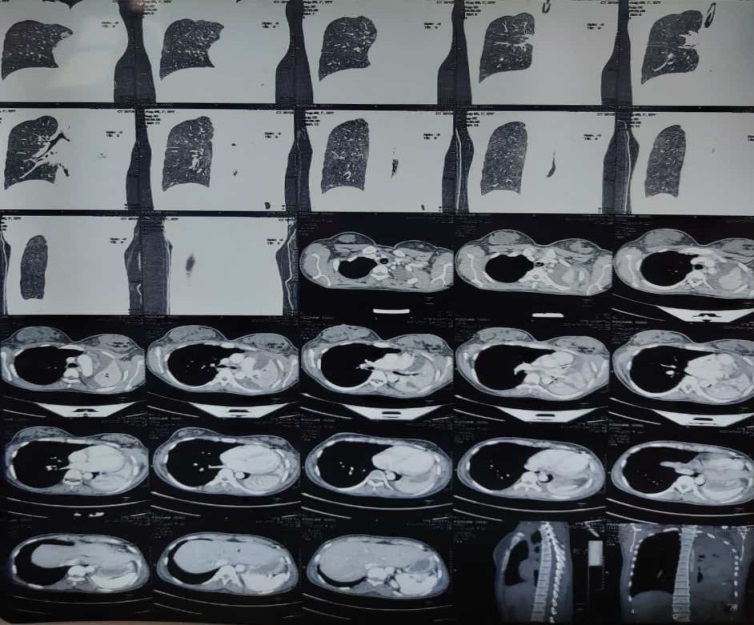 Figure 2: Contrast-enhanced computed tomography chest showing complete collapse of left lung, with mediastinal shift and pleural effusion with pneumothorax.