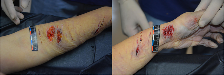 Figure 4: Incised Wound of Left Upper Limb.
