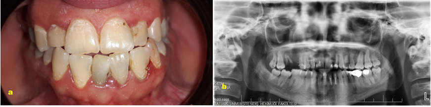 Figure 3: a) Postoperative clinical view six years after surgery; b) Postoperative panoramic radiograph view six years after surgery We state that we have followed the Helsinki Declaration (2008) and that written permission was obtained from both patient included in the present report.