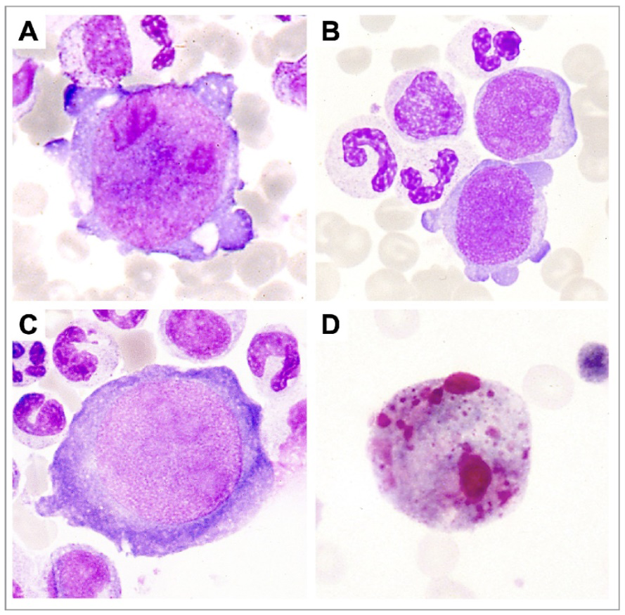 Figure 2: (Courtesy of Journal Haematologica – LN 230323). (A and B) Image showing marked erythroblast lineage hypoplasia. Additionally, there is atypical hyperbasophilic giant cells with very large, prominent nucleoli. These are giant cells also called giant pro-normoblasts, are pathognomonic of Parvo B19 infection. (C) An imaging showing an enormous pro-erythroblast with numerous nuclear inclusions. (D) An image showing atypical erythroblasts.