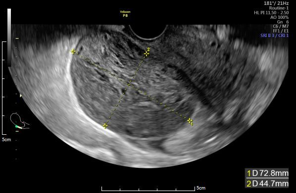 Figure 2: Pelvic T2-weighted MRI images: A: Before torsion occurred, typical PCO findings were recognized in bilateral normal sized ovaries (courtesy of previous hospital). B: At the torsion occurred, the left edematous ovary was found.
