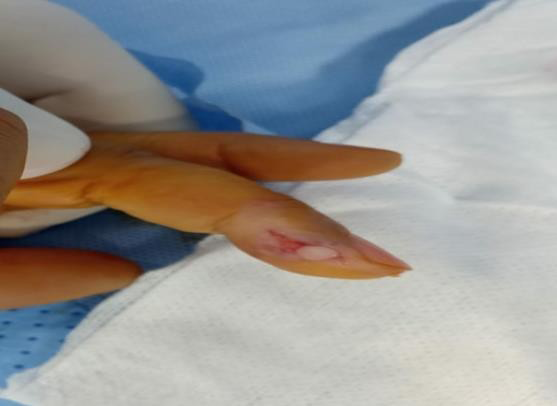 Figure 1: Direct lateral approach for lateral pulpal glomus tumor.