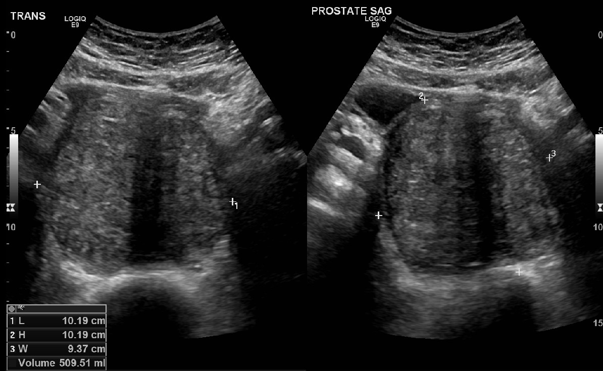 Figure 2: Ultrasound of the prostate (Transverse and sagittal view).