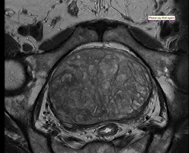 Figure 3: Axial T2 view of the Prostate MRI.