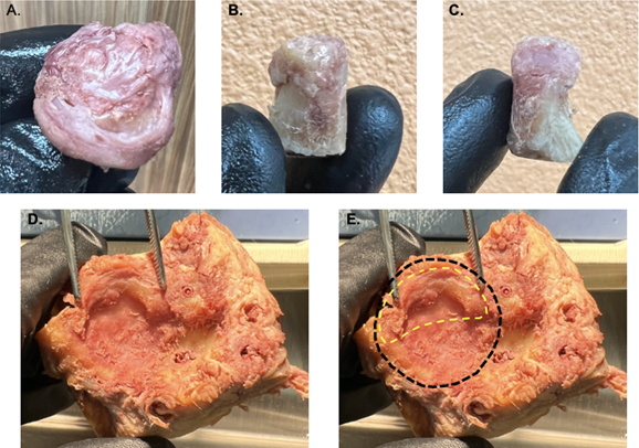 Figure 1: Demonstrates the disease severity of the mandibular condyle, fossa and articular disc on the 93-years-old female donor. (A.) Image represents the donor’s right mandibular condyle with remnants of the remaining, degenerated articular disc. The condyle’s articular cartilage demonstrates severe erosions on the medial (B.) and lateral (C.) aspects. (D.) Image represents the mandibular fossa of the temporal bone with forceps flanking the substantial bony erosion on the articular eminence (E.) Represents the approximate total surface area (black dashed line) of the mandibular fossa with an approximation of the pre- degeneration margin of the articular eminence (yellow dashed line).