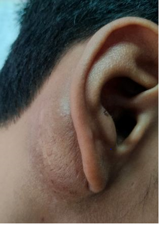 Figure 1: Swelling Behind Right Ear.