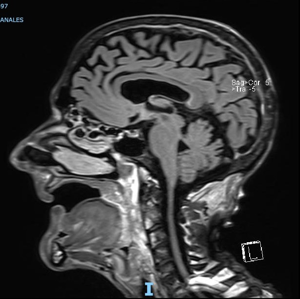 Figure 5: Magnetic resonance image sagittal view showing airway displacement.