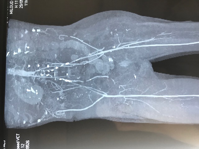 Figure 3: Angiography aorto bi-iliac occlusion.
