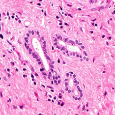 Figure 1: Extrahepatic cholangiocarcinoma demonstrating glandular articulations layered with mucin imbued columnar epithelial cells with vesicular nuclei, prominent nucleoli and minimal cellular and nuclear atypia. Surrounding stroma is desmoplastic.