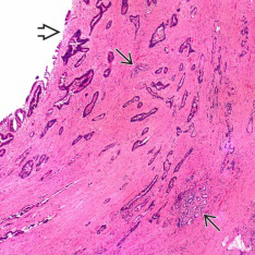 Figure 2: Extrahepatic cholangiocarcinoma delineating several glandular articulations lined by atypical, mucin secreting columnar epithelial cells with vesicular nuclei and conspicuous nucleoli. Circumscribing stroma is desmoplastic.