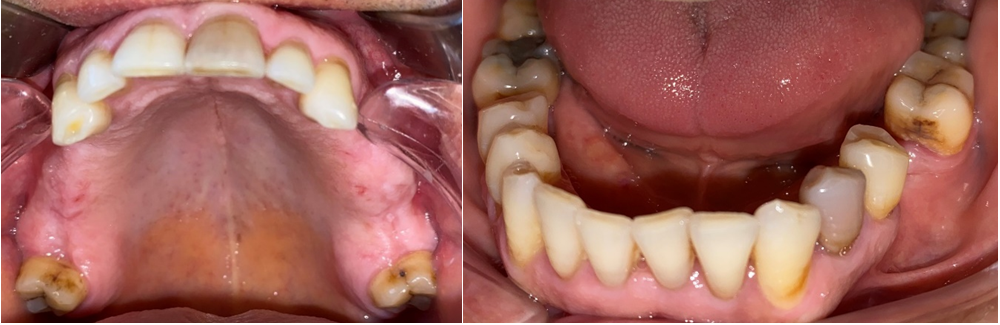 Figure 1: Intra-oral photos: a- Maxillary arch, b- Mandible arch.