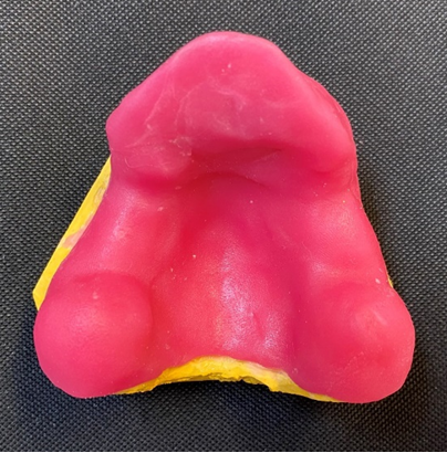 Figure 2: Maxillary custom tray.