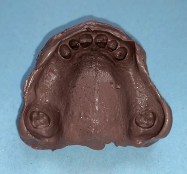 Figure 3: Maxillary definitive impression.