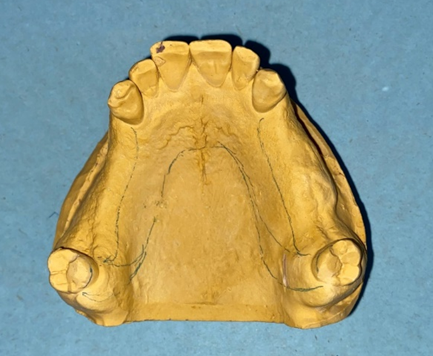 Figure 4: Maxillary master cast.