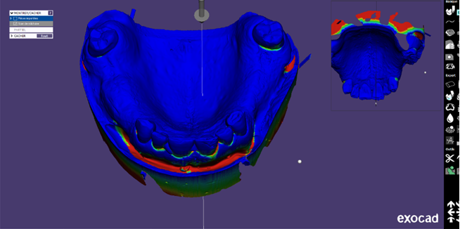 Figure 5: Digital preparation of the virtual model of master cast.