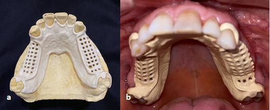 Figure 8: a. PEEK framework fitted on master cast; b. Intra oral try in of the PEEK framework.