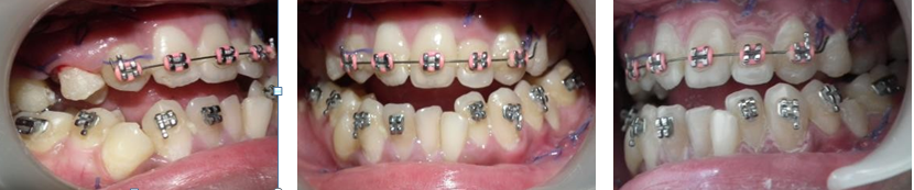 Figure 4: Upper alignment completed prior to distractor placement.