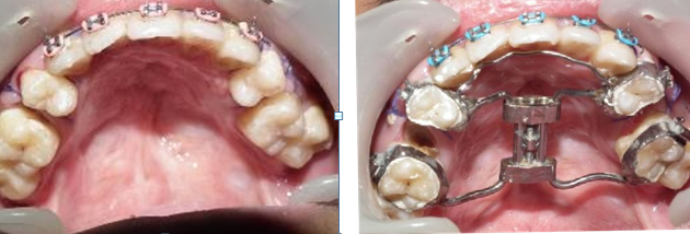 Figure 5: Pre and post distraction.