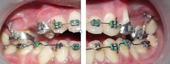 Figure 6: Infrazygomatic mini plates for posterior teeth intrusion.
