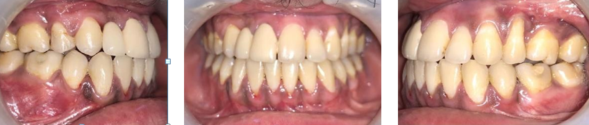 Figure 8: Post treatment extra oral and intraoral photographs.