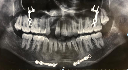 Figure 9: Post treatment radiographs.