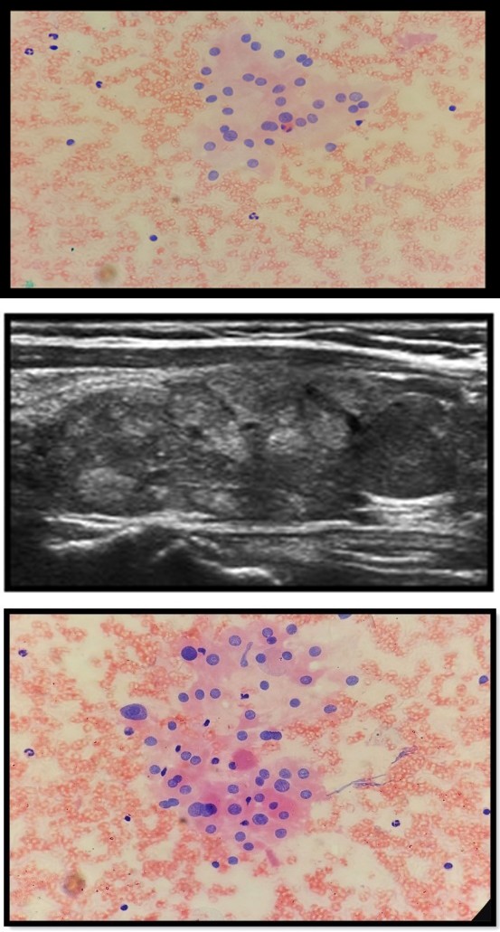 Figure 1: Right thyroid lobe with smooth margins.