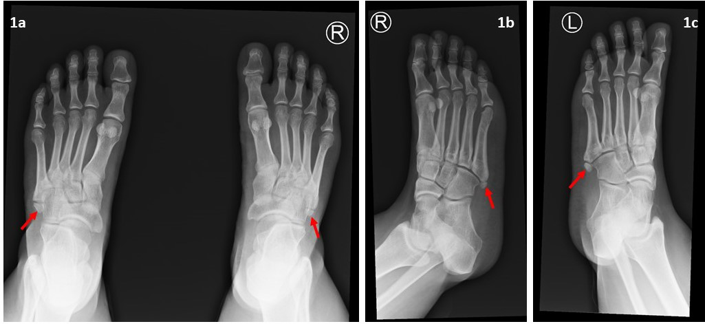 Figure 1: Bilateral foot radiograph. Dorsoplantar (1a) and oblique radiograph of the right (1b) and left (1c) foot demonstrate small symmetrical ossicle at the base of fifth metatarsal bone bilaterally (red arrows).