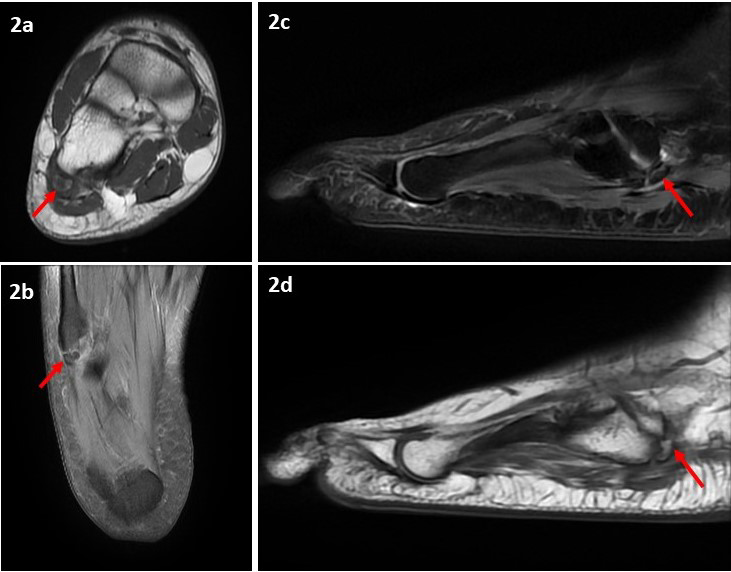 Figure 2: MRI of the right foot. Axial T1 non-fat saturation (2a), coronal fluid sensitive fat saturation (2b), sagittal fluid sensitive fat saturation (2c) and sagittal T1 non-fat saturation sequences demonstrate small ossicle at the base of fifth metatarsal bone that follow the signal intensity of the bone marrow (red arrows).
