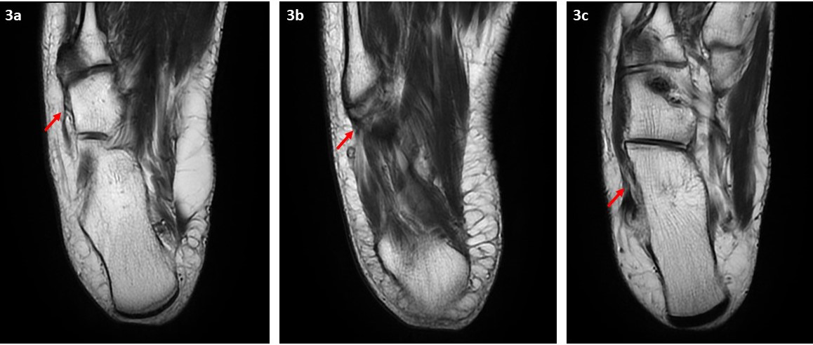 Figure 3: MRI of the right ankle. Axial T1 non-fat saturation sequences demonstrate the attachment of peroneus brevis tendon to the base of fifth metatarsal bone (3a) and OVP (3b) (red arrows). The peroneus brevis tendon is thickened and shows intermediate signal intensity at the inframalleolar fossa; denoting chronic tendinosis (3c) (red arrow).