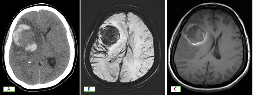 Figure 1: CT Scan (A) shows bleed in the right frontal lobe with subarachnoid haemorrhage. Subsequent SWI (B) and T1W (C) shows same findings. Subsequent on DSA patient has tumour blush and was diagnosed as glioblastoma.