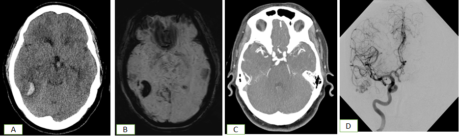 Figure 5: CT Scan (A) shows bleed in the right frontal lobe. Subsequent SWI (B) shows blood and CTA (C) and DSA (D) show right pial AVM.
