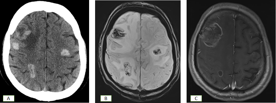Figure 6: CT Scan (A) shows bleed at grey white junctions .Subsequent SWI (B) shows blood and T1wC MRI (C)shows rim enhancing lesions.