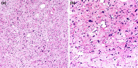 Figure 2: Pleomorphic liposarcoma enunciating variable quantities of pleomorphic lipoblasts commingled with high grade, undifferentiated, pleomorphic sarcoma composed of spindle shaped cells with hyperchromatic nuclei. Foci of necrosis and prominent mitotic activity are observed [7].