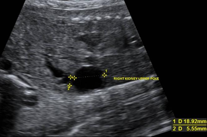 Figure 1: Right kidney upper pole and dilated pelvis. There was no other system additional structural anomaly. Fetal cardiac examination revealed normal findings. Cordocentesis is performed for karyotyping due to maternal anxiety. Fetal blood sampling revealed a normal 46, XYkaryo type. The patient delivered a male weighing 3200gram, withApgar scores of 9 and 10 at 1 and 5 min, respectively. Postnatal, surgery is planned for hydronephrotic kidney by pediatric urology.