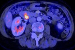 Figure 1: View of the mass in the duodenum/pancreatic head by PET-CT scan.
