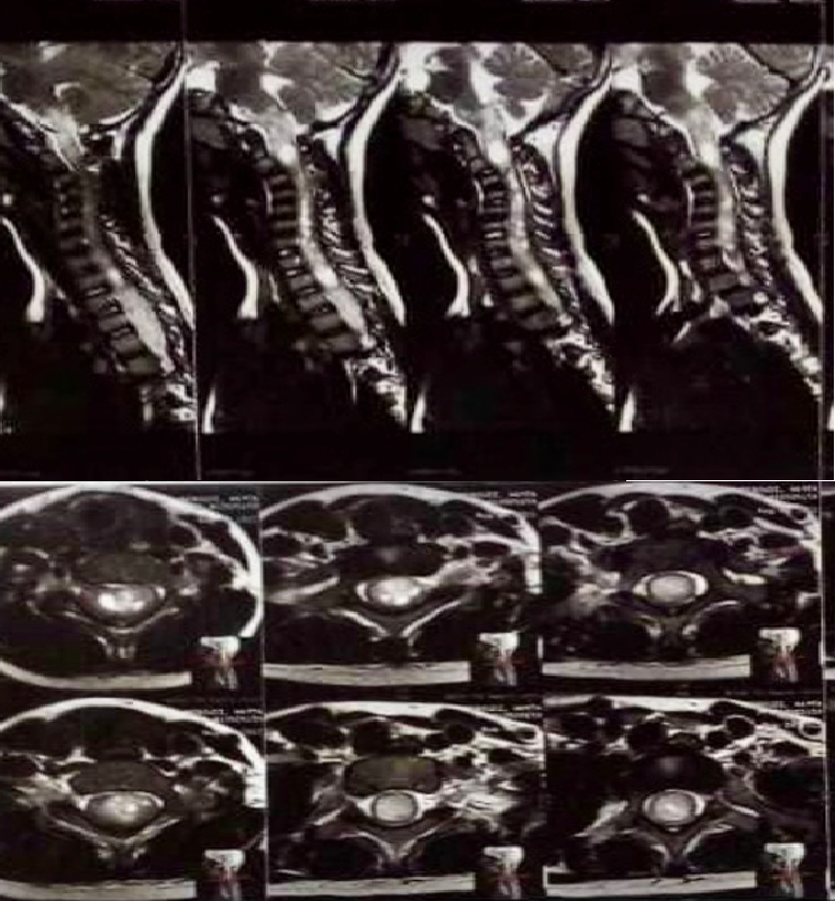 Figure 1: Preoperative sagittal and axial MRI with contrast of the cervical spine; significant for enhancing mass from C1-C7 measuring 60 mm craniocaudal span (First patient).