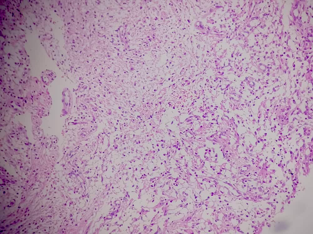 Figure 3: Neoplastic cells with vascular proliferation and focal necrosis on hematoxylin and eosin stains (100×).