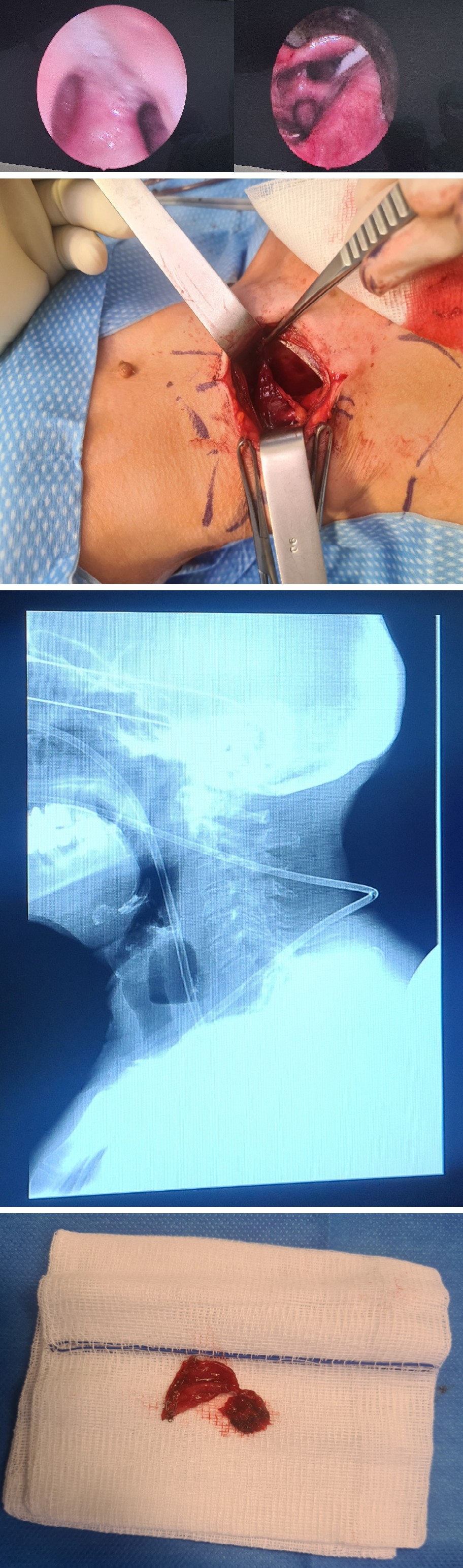 Figure 1: Illustration of Zenker’s diverticulum.