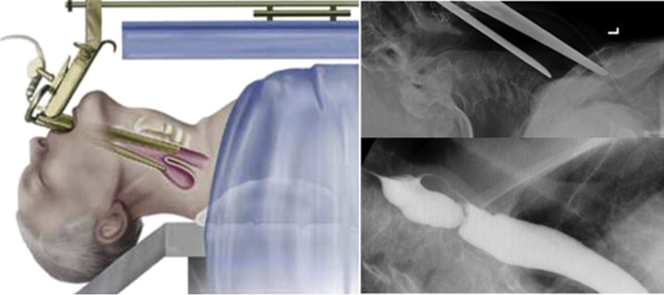 Figure 4: Exposure of the diverticula using a diverticuloscope.