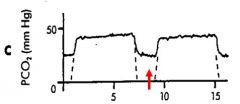 Figure 3: Abnormal capnogram due to expiratory valve malfunction – red arrow indicates rebreathing during expiratory limb. Inspiratory valve malfunction may not consistently show elevated baseline, Beta angle markedly increased and rebreathing occurs during inspiratory limb of waveform (Figure 4).