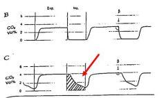 Figure 4: Abnormal capnogram due to inspiratory valve malfunction – red arrow indicates rebreathing during inspiratory limb; shaded area shows increased beta angle. Malfunctioning Co-axial circuit usually due to disconnected inspiratory inner tube; elevated ETCO2 with decreased ETCO2-arterial CO2 gradient seen.