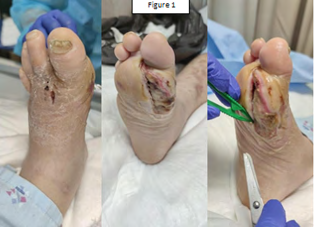 Figure 1: Because of his medical condition, many institutions offered him BKA amputation.