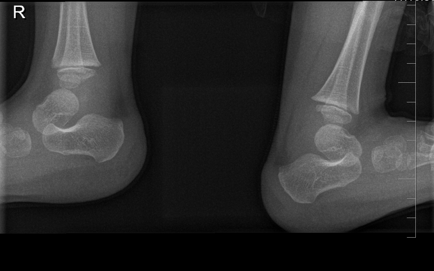 Figure 1: First X-Ray lateral view.