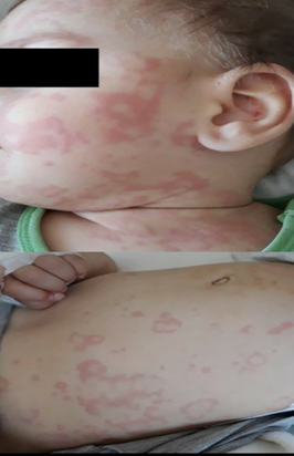 Figure 1: Target lesions on face and trunk.
