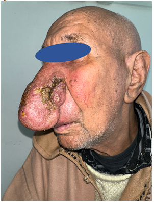 Figure 1: Bulbous mass covering the entire nose, with dilated sebum-filled pores.