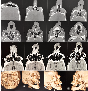 Figure 4: Craniofacial CT scan without concomitant bone involvement.