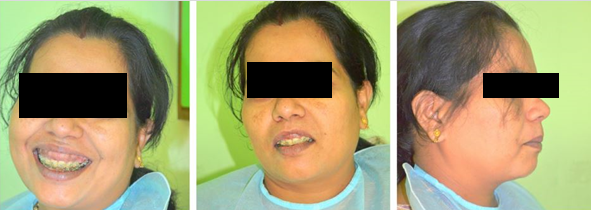 Figure 2: Profile photograph before plastic periodontal therapy.