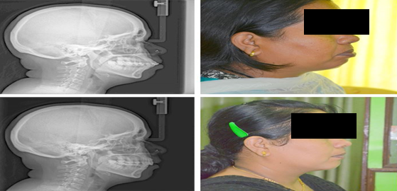 Figure 5: Immediate after Deboning.